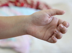 Ребенка из Еманжелинска не пускают в детский сад из-за отсутствия туберкулиновой пробы